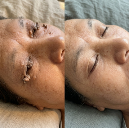 🧑‍⚕️ 𝐵𝑜𝑢𝑡𝑖𝑞𝑢𝑒 𝑂𝑓𝑓𝑖𝑐𝑖𝑒𝑙𝑙𝑒 |Healrize® 🌿𝑴𝒊𝒄𝒓𝒐𝒏𝒆𝒆𝒅𝒍𝒆𝒔 𝑷𝒆𝒂𝒖 𝑷𝒂𝒓𝒇𝒂𝒊𝒕𝒆 É𝒍𝒊𝒎𝒊𝒏𝒂𝒕𝒊𝒐𝒏 𝑫𝒆𝒔 𝑽𝒆𝒓𝒓𝒖𝒆𝒔 𝑷𝒂𝒕𝒄𝒉 (𝑃𝑜𝑢𝑟 𝑙𝑒𝑠 𝑎𝑐𝑟𝑜𝑐ℎ𝑜𝑟𝑑𝑜𝑛𝑠, 𝑙𝑒𝑠 𝑝𝑒𝑡𝑖𝑡𝑒𝑠 𝑒𝑥𝑐𝑟𝑜𝑖𝑠𝑠𝑎𝑛𝑐𝑒𝑠 𝑐𝑢𝑡𝑎𝑛é𝑒𝑠, 𝑙𝑒𝑠 𝑣𝑒𝑟𝑟𝑢𝑒𝑠, 𝑙𝑒𝑠 𝑔𝑟𝑎𝑖𝑛𝑠 𝑑𝑒 𝑏𝑒𝑎𝑢𝑡é, 𝑙𝑒𝑠 𝑡𝑎𝑐ℎ𝑒𝑠 𝑑𝑒 𝑣𝑖𝑒𝑖𝑙𝑙𝑒𝑠𝑠𝑒 𝑒𝑡 𝑙𝑒𝑠 𝑝𝑟𝑜𝑏𝑙è𝑚𝑒𝑠 𝑑𝑒 𝑝𝑖𝑔𝑚𝑒𝑛𝑡𝑎𝑡𝑖𝑜𝑛