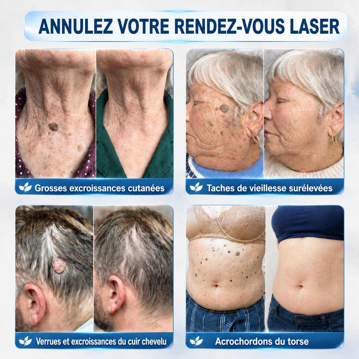 🧑‍⚕️ 𝐵𝑜𝑢𝑡𝑖𝑞𝑢𝑒 𝑂𝑓𝑓𝑖𝑐𝑖𝑒𝑙𝑙𝑒 |Healrize® 🌿𝑴𝒊𝒄𝒓𝒐𝒏𝒆𝒆𝒅𝒍𝒆𝒔 𝑷𝒆𝒂𝒖 𝑷𝒂𝒓𝒇𝒂𝒊𝒕𝒆 É𝒍𝒊𝒎𝒊𝒏𝒂𝒕𝒊𝒐𝒏 𝑫𝒆𝒔 𝑽𝒆𝒓𝒓𝒖𝒆𝒔 𝑷𝒂𝒕𝒄𝒉 (𝑃𝑜𝑢𝑟 𝑙𝑒𝑠 𝑎𝑐𝑟𝑜𝑐ℎ𝑜𝑟𝑑𝑜𝑛𝑠, 𝑙𝑒𝑠 𝑝𝑒𝑡𝑖𝑡𝑒𝑠 𝑒𝑥𝑐𝑟𝑜𝑖𝑠𝑠𝑎𝑛𝑐𝑒𝑠 𝑐𝑢𝑡𝑎𝑛é𝑒𝑠, 𝑙𝑒𝑠 𝑣𝑒𝑟𝑟𝑢𝑒𝑠, 𝑙𝑒𝑠 𝑔𝑟𝑎𝑖𝑛𝑠 𝑑𝑒 𝑏𝑒𝑎𝑢𝑡é, 𝑙𝑒𝑠 𝑡𝑎𝑐ℎ𝑒𝑠 𝑑𝑒 𝑣𝑖𝑒𝑖𝑙𝑙𝑒𝑠𝑠𝑒 𝑒𝑡 𝑙𝑒𝑠 𝑝𝑟𝑜𝑏𝑙è𝑚𝑒𝑠 𝑑𝑒 𝑝𝑖𝑔𝑚𝑒𝑛𝑡𝑎𝑡𝑖𝑜𝑛