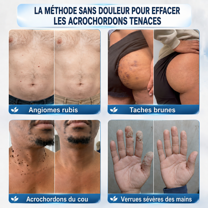 🧑‍⚕️ 𝐵𝑜𝑢𝑡𝑖𝑞𝑢𝑒 𝑂𝑓𝑓𝑖𝑐𝑖𝑒𝑙𝑙𝑒 |Healrize® 🌿𝑴𝒊𝒄𝒓𝒐𝒏𝒆𝒆𝒅𝒍𝒆𝒔 𝑷𝒆𝒂𝒖 𝑷𝒂𝒓𝒇𝒂𝒊𝒕𝒆 É𝒍𝒊𝒎𝒊𝒏𝒂𝒕𝒊𝒐𝒏 𝑫𝒆𝒔 𝑽𝒆𝒓𝒓𝒖𝒆𝒔 𝑷𝒂𝒕𝒄𝒉 (𝑃𝑜𝑢𝑟 𝑙𝑒𝑠 𝑎𝑐𝑟𝑜𝑐ℎ𝑜𝑟𝑑𝑜𝑛𝑠, 𝑙𝑒𝑠 𝑝𝑒𝑡𝑖𝑡𝑒𝑠 𝑒𝑥𝑐𝑟𝑜𝑖𝑠𝑠𝑎𝑛𝑐𝑒𝑠 𝑐𝑢𝑡𝑎𝑛é𝑒𝑠, 𝑙𝑒𝑠 𝑣𝑒𝑟𝑟𝑢𝑒𝑠, 𝑙𝑒𝑠 𝑔𝑟𝑎𝑖𝑛𝑠 𝑑𝑒 𝑏𝑒𝑎𝑢𝑡é, 𝑙𝑒𝑠 𝑡𝑎𝑐ℎ𝑒𝑠 𝑑𝑒 𝑣𝑖𝑒𝑖𝑙𝑙𝑒𝑠𝑠𝑒 𝑒𝑡 𝑙𝑒𝑠 𝑝𝑟𝑜𝑏𝑙è𝑚𝑒𝑠 𝑑𝑒 𝑝𝑖𝑔𝑚𝑒𝑛𝑡𝑎𝑡𝑖𝑜𝑛